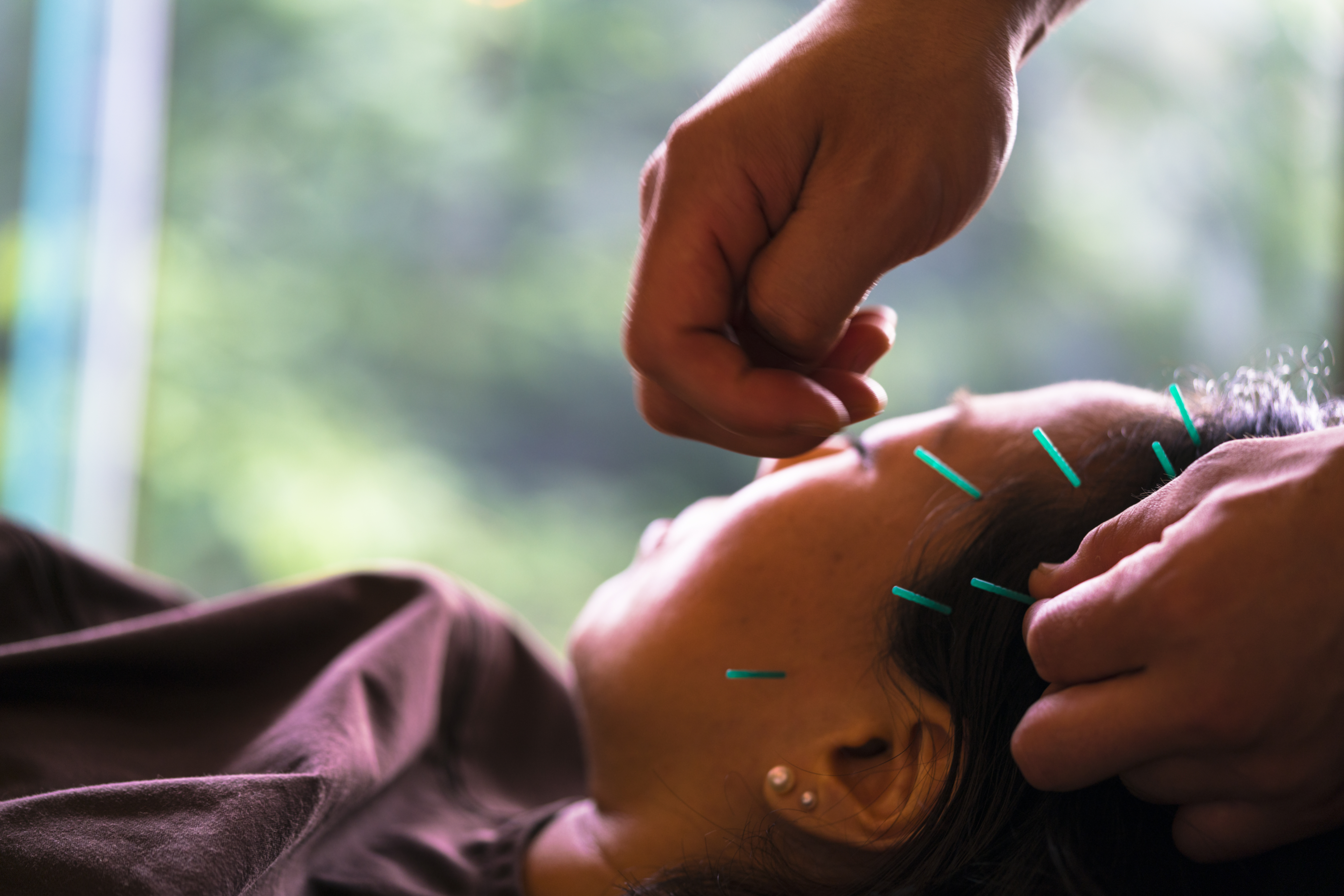 Woman getting acupuncture