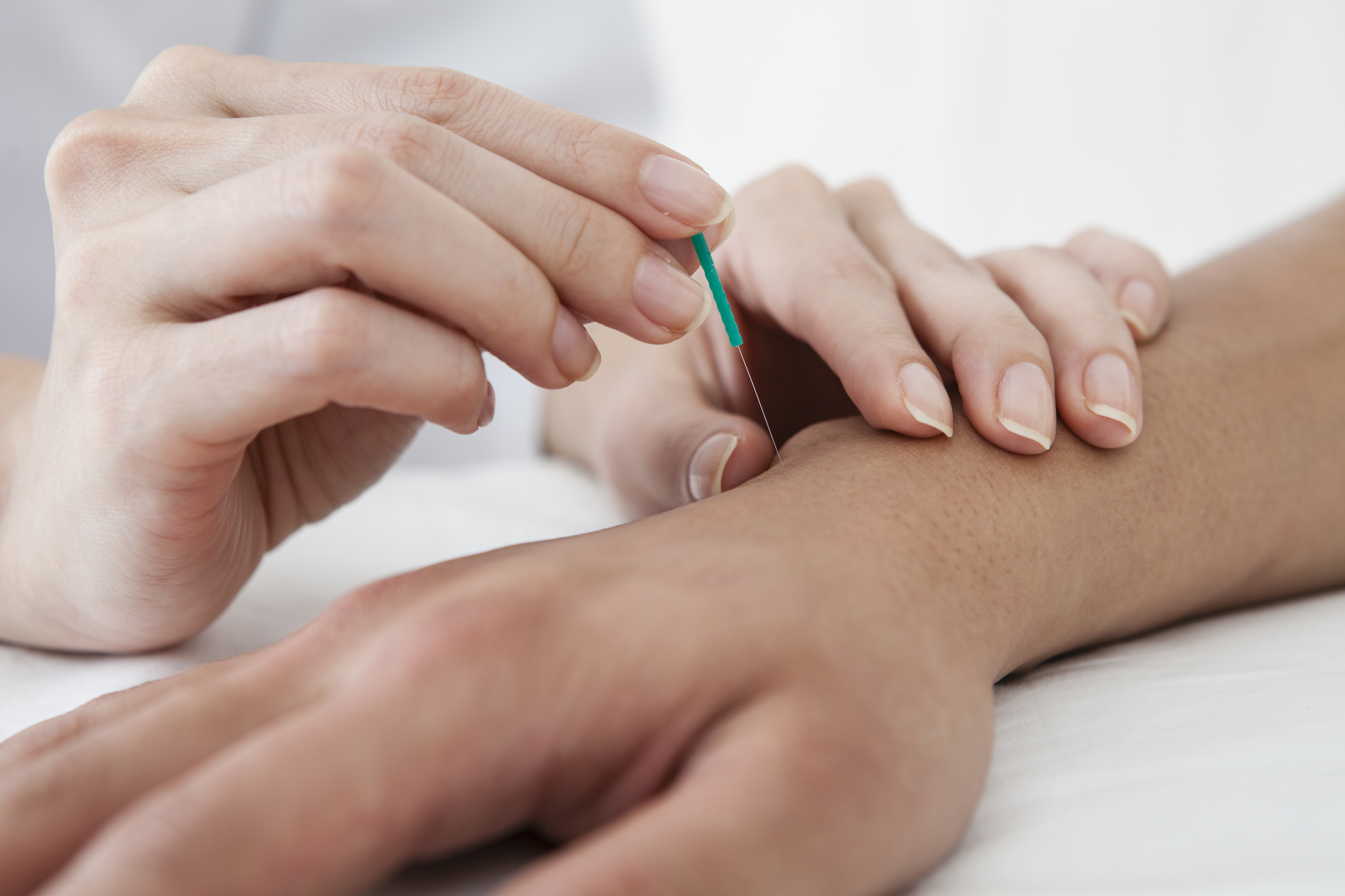 Hand receiving acupuncture